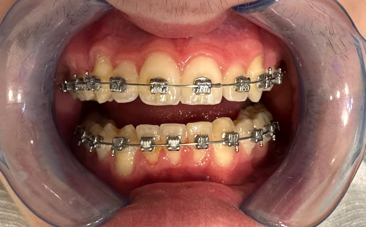 image comparison after